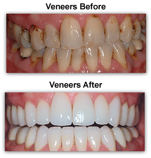 Dental Veneers Colmar PA