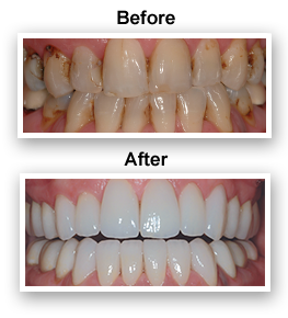 Teeth Whitening Dentist Colmar PA