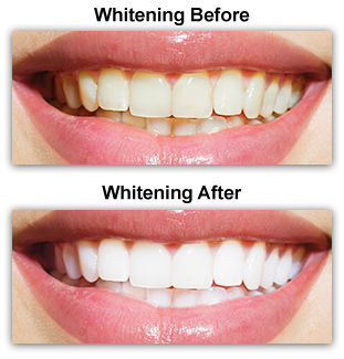 Teeth Whitening Dentist Colmar PA