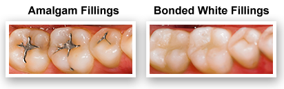 White Dental Fillings Colmar Pa